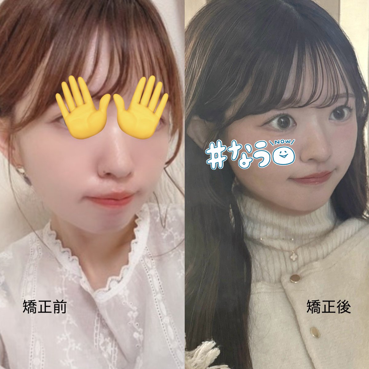 _narrowgate's tweet image. 久しぶりに矯正ビフォアフ。
上顎の厚みがなくなって、人中短縮された🥹