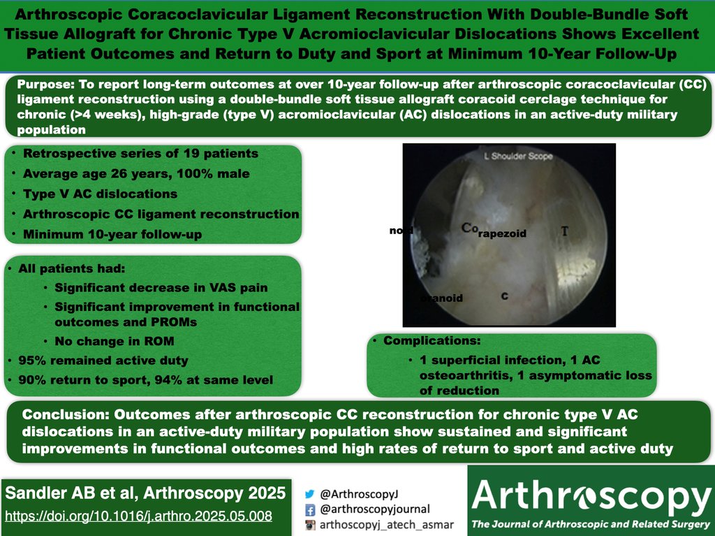 This #VisualAbstract shows promising long-term outcomes after arthroscopic CC ligament reconstruction in chronic Type V AC dislocations. 

arthroscopyjournal.org/article/S0749-…