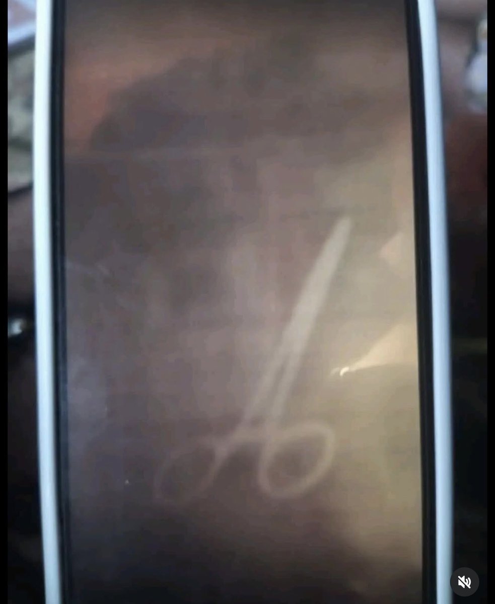 silverpenydr's tweet image. They forgot  scissor inside her during a surgery and now she’s de@d as a result ? 😳