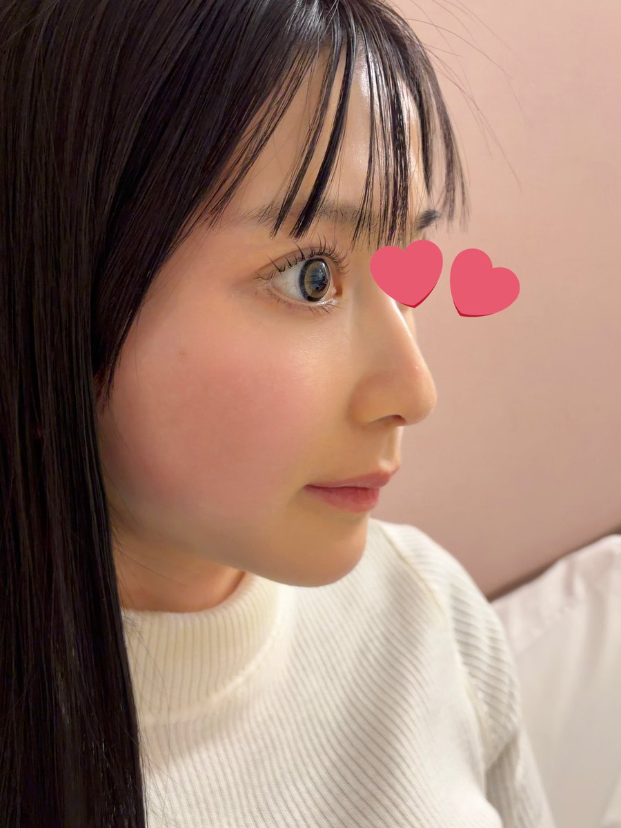 me_o089's tweet image. 🏥PAGE LAB CLINIC

✔ウルセラ500shot
✔オンダリフト80J
✔スキンボトックス
✔唾液腺ボトックス

ウルセラはどこのクリニックを受けようか悩み、キードクターのいるペイジレップクリニックへ🎀

スタッフさんの対応も施術も忖度なしでおすすめできるクリニックでした！😭

@Pagelab_kr