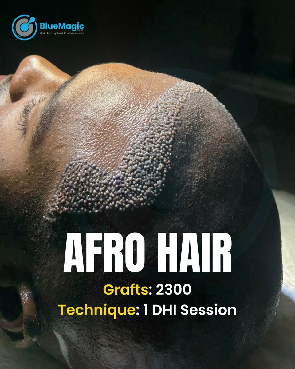 BrittanyLa62094's tweet image. Afro Hair Transplant.
2300 grafts.
1 DHI session.

Precision, angles, density: Afro hair needs experience, not shortcuts.

Follow @bluemagicgroupinternational on Instagram for a free medical evaluation.

#hairtransplantturkey #hairline #grafts #afrohair #bluemagicgroup