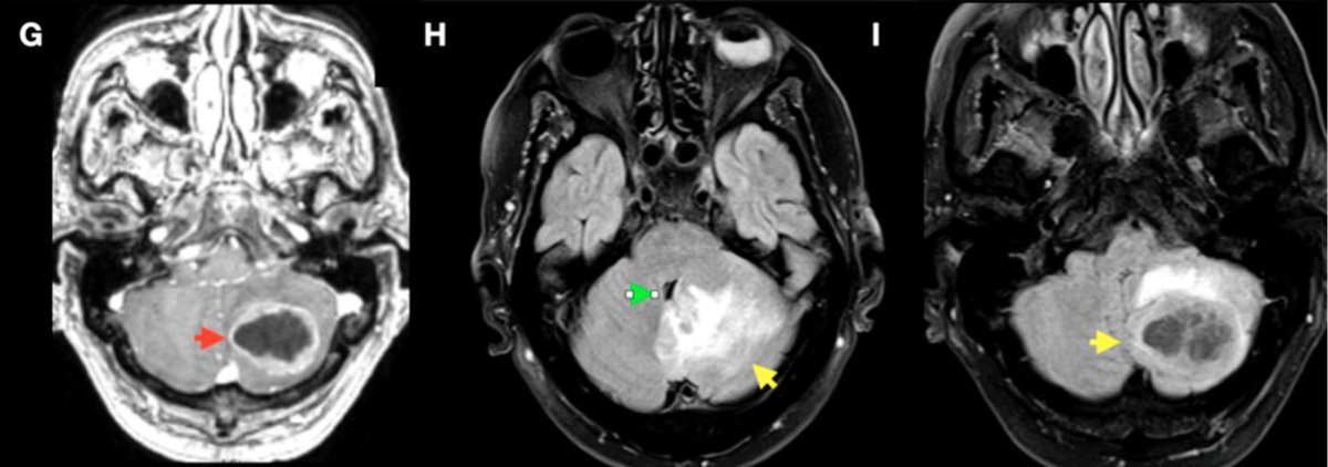 JMSVillalobos's tweet photo. Posterior fossa brain mets are a distinct clinical problem: tight anatomy around the brainstem and 4th ventricle means small volume changes can have big consequences (neurological decline / hydrocephalus risk). We evaluated frameless LINAC VMAT-SRS specifically in this setting. https://t.co/51dMFP3SLZ