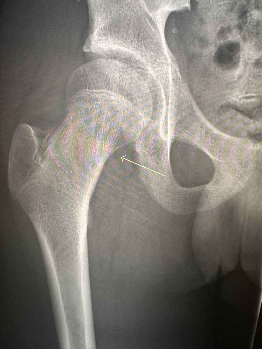 northwoods1980's tweet photo. An absolute do not miss case. And don't presume in 2026 a solid history and exam from will save you or the patient.  if this neck fracture is missed and patient returns with a disaster https://t.co/lGNVknwZQs