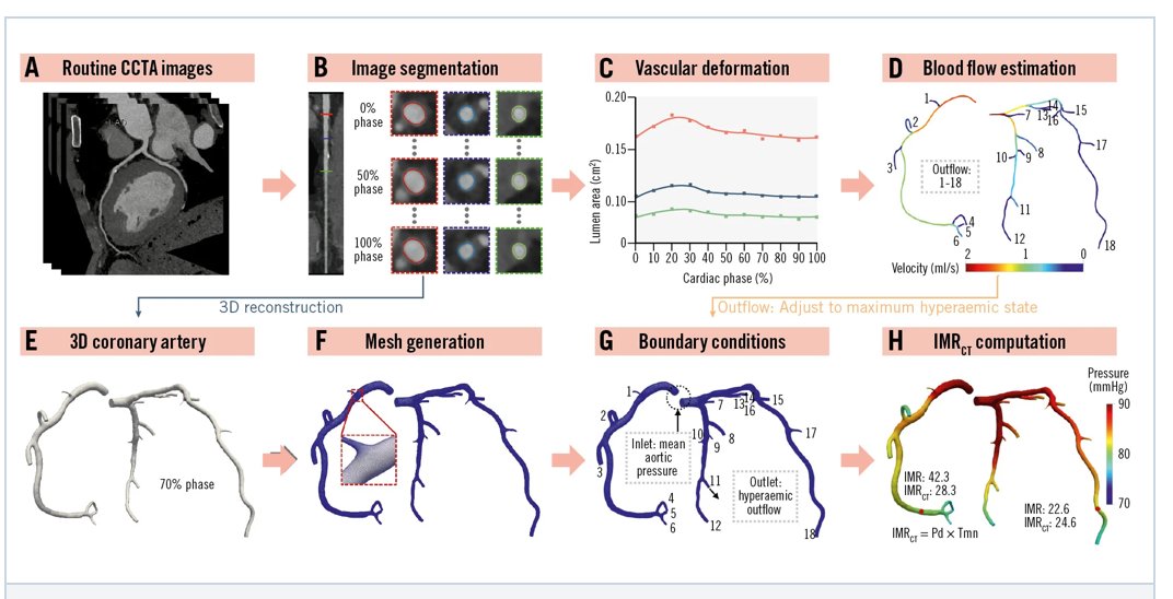 EuroInterventio's tweet image. This CCTA-derived index of microcirculatory resistance (IMRCT) showed good agreement with invasive IMR and substantially reduced underdiagnosis of coronary microvascular disease.
A step toward non-invasive microvascular assessment.

Read more here: 
eurointervention.pcronline.com/article/non-in…

#CMD