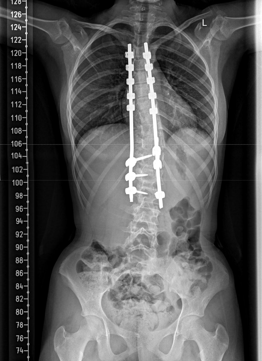 Orthophilic's tweet image. Amazing illustration 

موقع OperativeInk.com
وهو موقع طبي يساعد الأطباء على شرح العمليات برسومات واضحة وبسيطة.
الصور توضح حالة حقيقية لأحد مرضاي قبل وبعد عملية تصحيح #الجنف 
مع الحفاظ الكامل على خصوصية المريض وعدم إظهار أي معلومات شخصية او مناظر حساسة