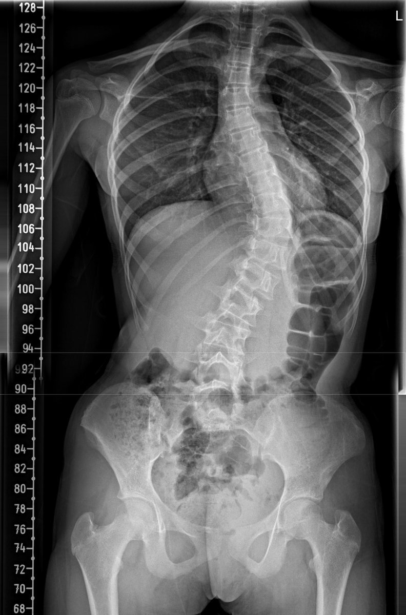 Orthophilic's tweet image. Amazing illustration 

موقع OperativeInk.com
وهو موقع طبي يساعد الأطباء على شرح العمليات برسومات واضحة وبسيطة.
الصور توضح حالة حقيقية لأحد مرضاي قبل وبعد عملية تصحيح #الجنف 
مع الحفاظ الكامل على خصوصية المريض وعدم إظهار أي معلومات شخصية او مناظر حساسة