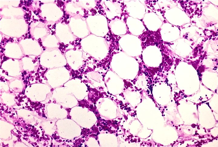 Quality_bio's tweet photo. #معلومة_سريعة
ا Aplastic Anemia
❶ تدمير الخلايا المكونة للدم
❷ يحدث بسبب إشعاع أو أدوية
❸ يسبب Pancytopenia كاملة
❹ نخاع العظم فقير بالخلايا
 #مختبرات_طبية https://t.co/npzLFE9f4x