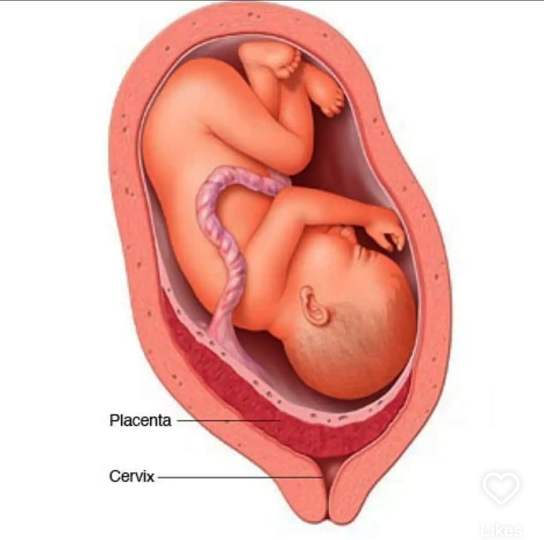 THE BLEEDING FROM PLACENTA PREVIA CAN FILL A DRUM IN MINUTES.

NEVER PUT YOUR HAND IN THE VAGINA.  IF YOU DO MISTAKENLY, NEVER REMOVE THAT FINGER TILL YOU GET INTO THE THEATRE. 

Read,  SHARE, REPOST

The Wisdom of Not Touching: When Silence, and Pause, and Restraint Save Two