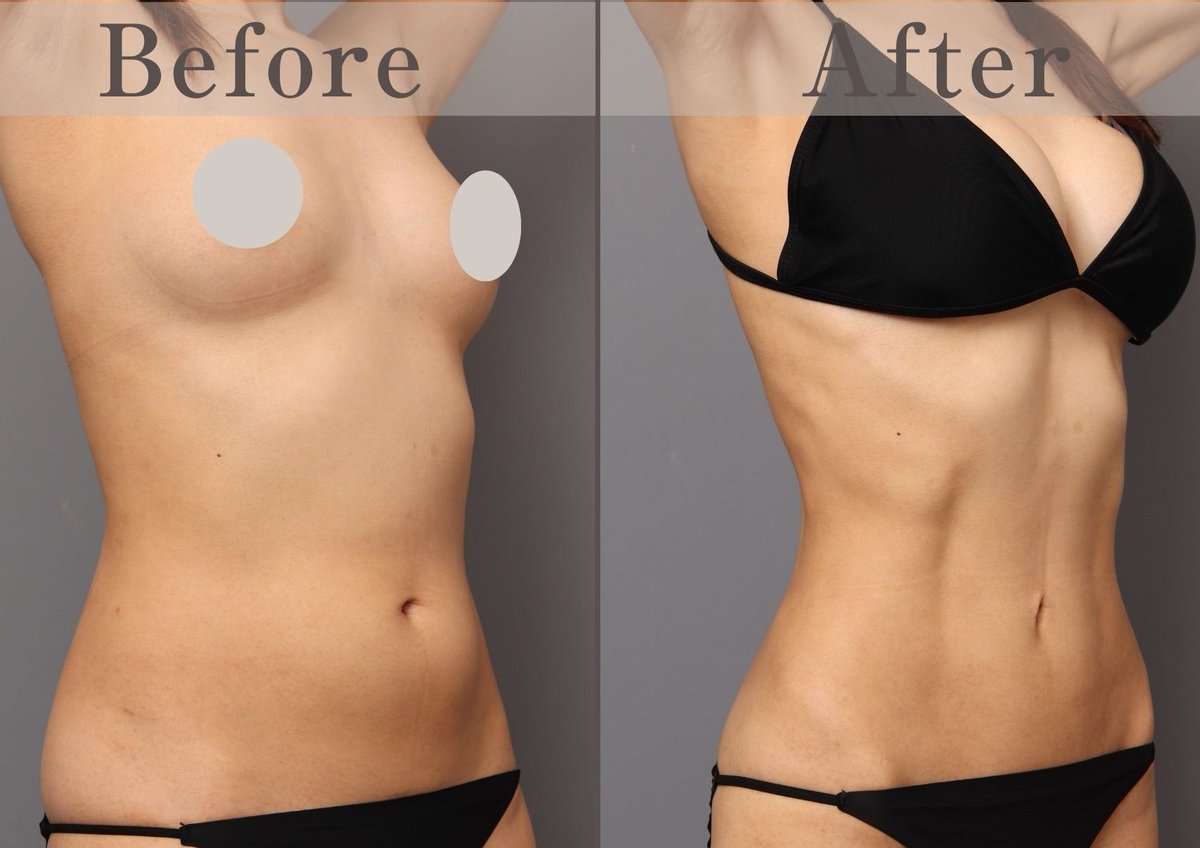 志田雅明 美容外科医|ハイブリッド豊胸・バービーウエスト・脂肪吸引・脂肪豊胸 tweet media