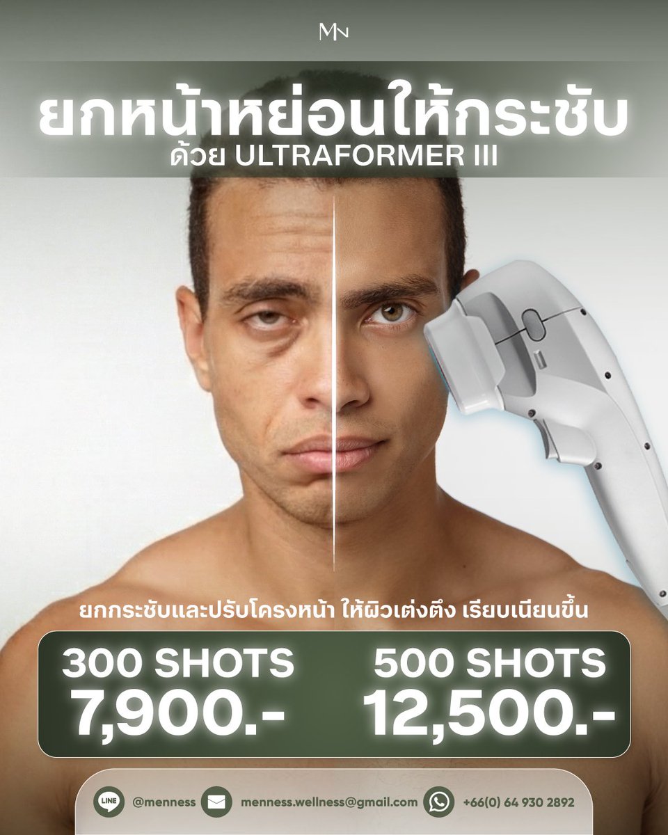 หน้าเริ่มหย่อน? กรอบหน้าไม่ชัด? ให้ Ultraformer III ที่ Menness Clinic ช่วยยกใบหน้าให้กลับมากระชับอีกครั้ง 💥 ยกกระชับลึกถึงชั้นผิว เห็นผลจริง ปลอดภัย ไม่ต้องพักฟื้น
.
ราคาพิเศษตอนนี้
📍 300 Shots 7,900.-
📍 500 Shots 12,500.-
.
✔️ ยกกระชับ
✔️ ปรับรูปหน้า
✔️ ผิวดูเรียบเนียนขึ้น