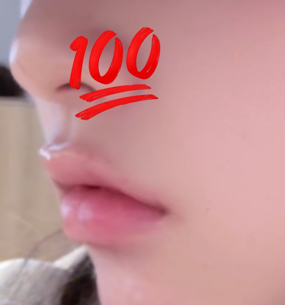 I6mqy's tweet photo. 唇ヒアル 直後だけどすでに完成が楽しみ過ぎるт т

江南のセリンクリニック🏥
アップセルあったけど、断れる雰���気！女医さんも通訳さんもみんな優しいから安心して施術できたし院内キレイ🫶
施術途中に鏡渡されてもう少し入れる？って相談してくれた！

レスチレンキス 1ccで350000ウォンでした🙇🏻 https://t.co/fWmWdVLUA5