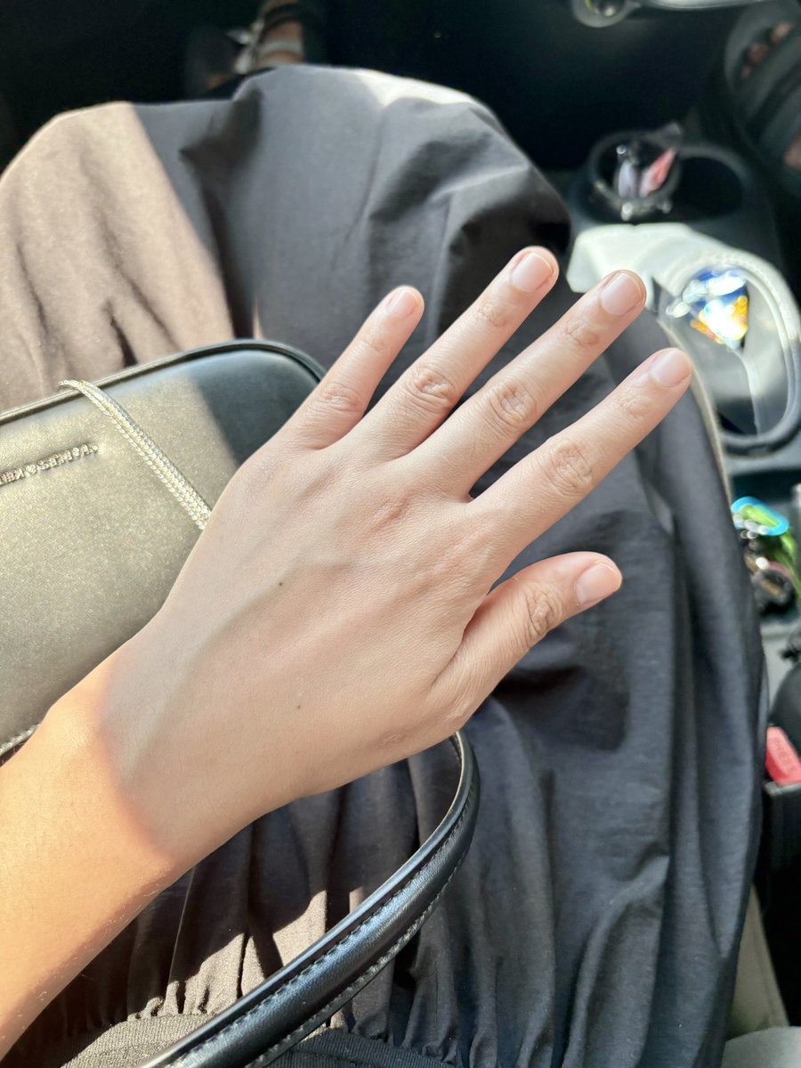 ayuaqilahj's tweet photo. 5 bulan dah pakai lotion Eucerin ni. Memang putih healthy and lembab kulit jadinyaa.

Nothing crazy but jelas la nampak urat hijau tu. Ketara sangat beza dia dengan kulit yang dulu. 

Parut gelap and dark area semua hilang. Memang rugi tak try awal!😍 https://t.co/mKf7UILRgw