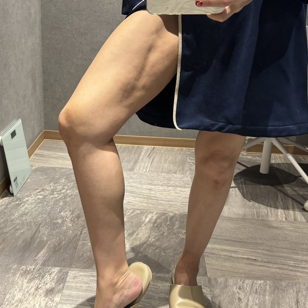 hrch_213's tweet image. 脂肪吸引を考えてるみなさん、先生選び間違えるとこんな事になります😇😇😇
私は某クリニックで脂肪豊胸のために脂肪吸引をしたんだけど取られ過ぎてこんな凸凹になりました。
ちなみに脂肪豊胸もほぼ定着せず、しこりが大量に出来て除去手術に50万円かかったよ💸