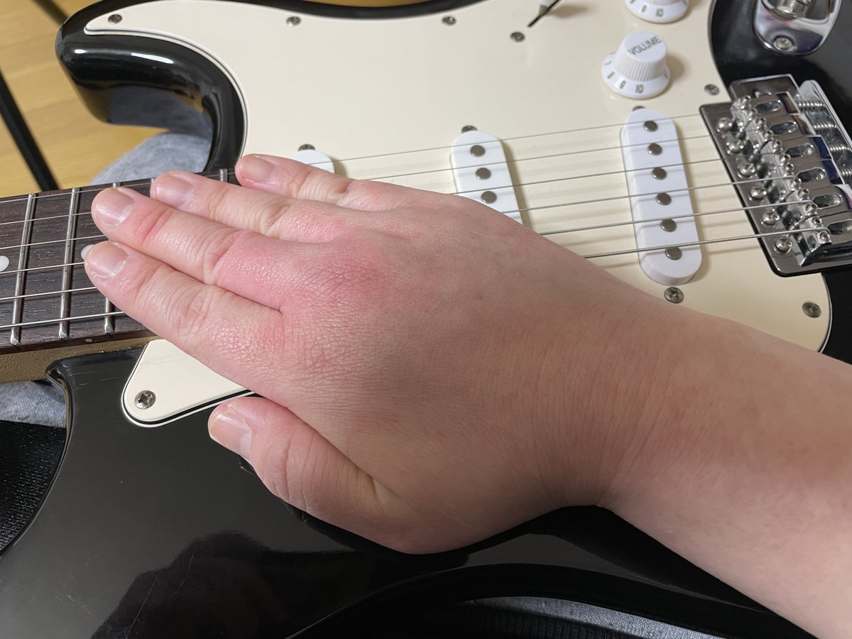 ohagi228's tweet image. 手の甲が赤くなり始めたので本日のギター練習は終了します(寒冷蕁麻疹)