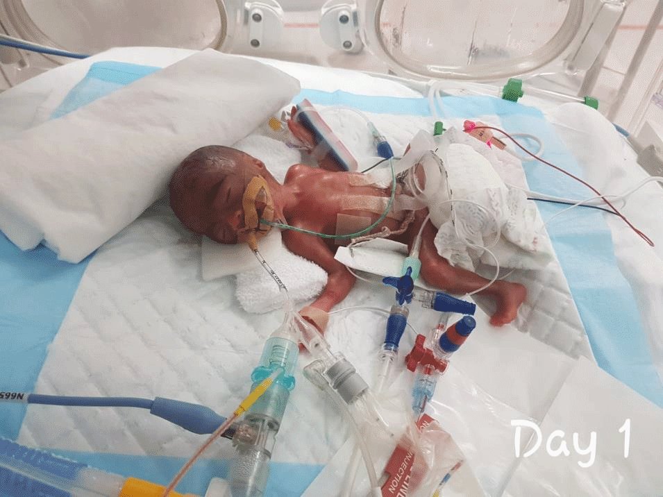 Paedoeconsult's tweet photo. Today, the smallest surviving preterm baby I successfully managed as the head of the newborn unit celebrated his first birthday. He was born at 26 weeks gestation and weighed only 750g. He battled many problems of premies and came out strong. This is my joy as a Paediatrician. https://t.co/3mWnYmleHB