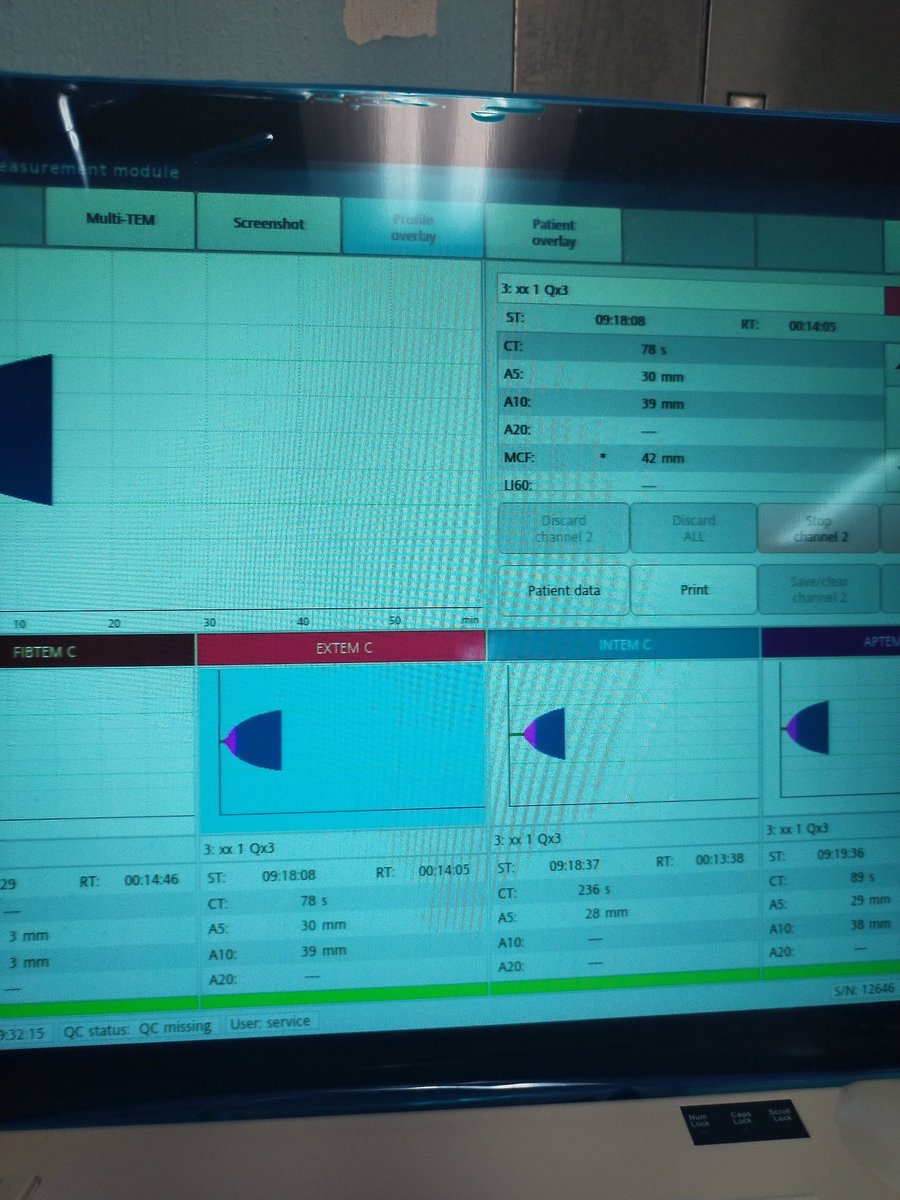 NapolenMndez1's tweet image. Día histórico para el @HospigenGT, primer hospital del sistema público que tiene pruebas de coagulación como en primer mundo. Hoy estrenamos el ROTEM y será un antes y un después para los pacientes traumatizados.