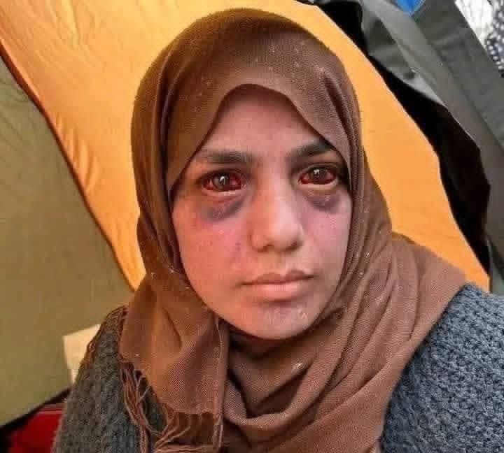 هذه ليست صورة عابرة، بل حكاية وجع.

أمٌّ فقدت ثلاثة من أبنائها، فتركت الفاجعة أثرها على عينيها وملامحها.

احمرار العينين وانتفاخهما نتيجة بكاء طويل وصدمة قاسية، بعد خسارة لا تُحتمل.

مشهد يختصر حجم المعاناة النفسية التي تعيشها أمهات كثيرات في غزة، حيث الفقد يتكرر، والحزن لا يجد