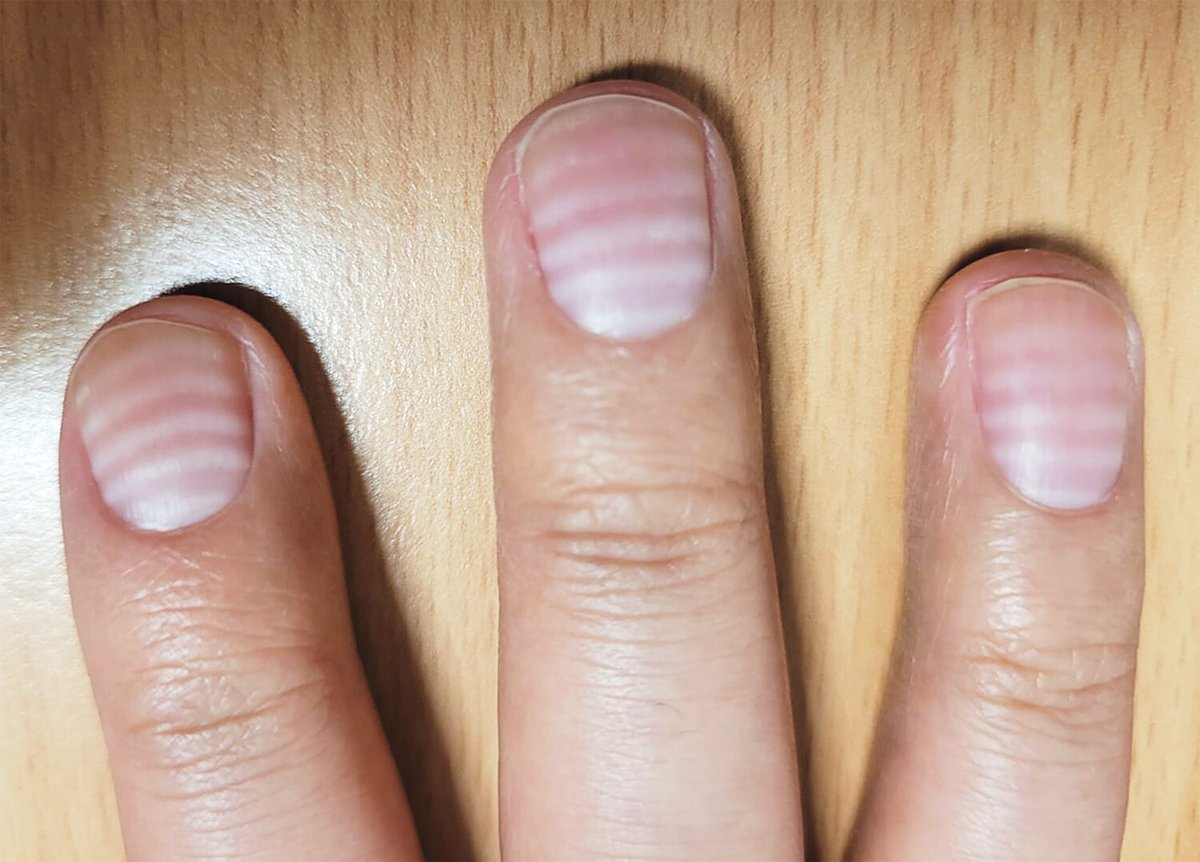 36 year old man taking herbal medication for erectile dysfunction. 

Presents with history of numbness with painful paraesthesias in limbs. He has rain drop pigmentation seen over posterior aspect of trunk and nail findings as in the image.

What caused this?

Image from <a href="/NEJM/">NEJM</a>