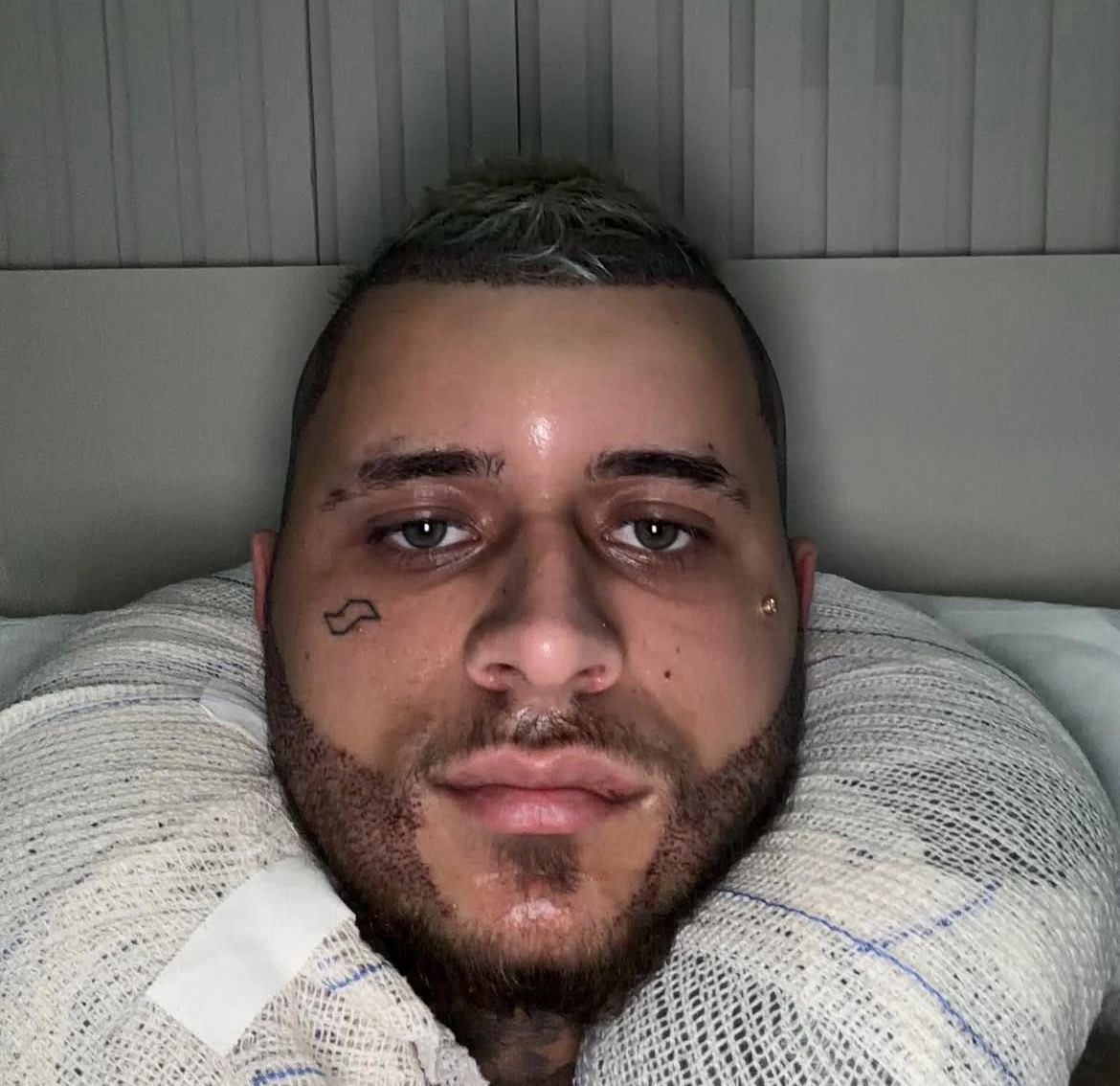 QGdoPOP's tweet image. Mc Pedrinho realiza transplante capilar e mostra o pós com inchaços.