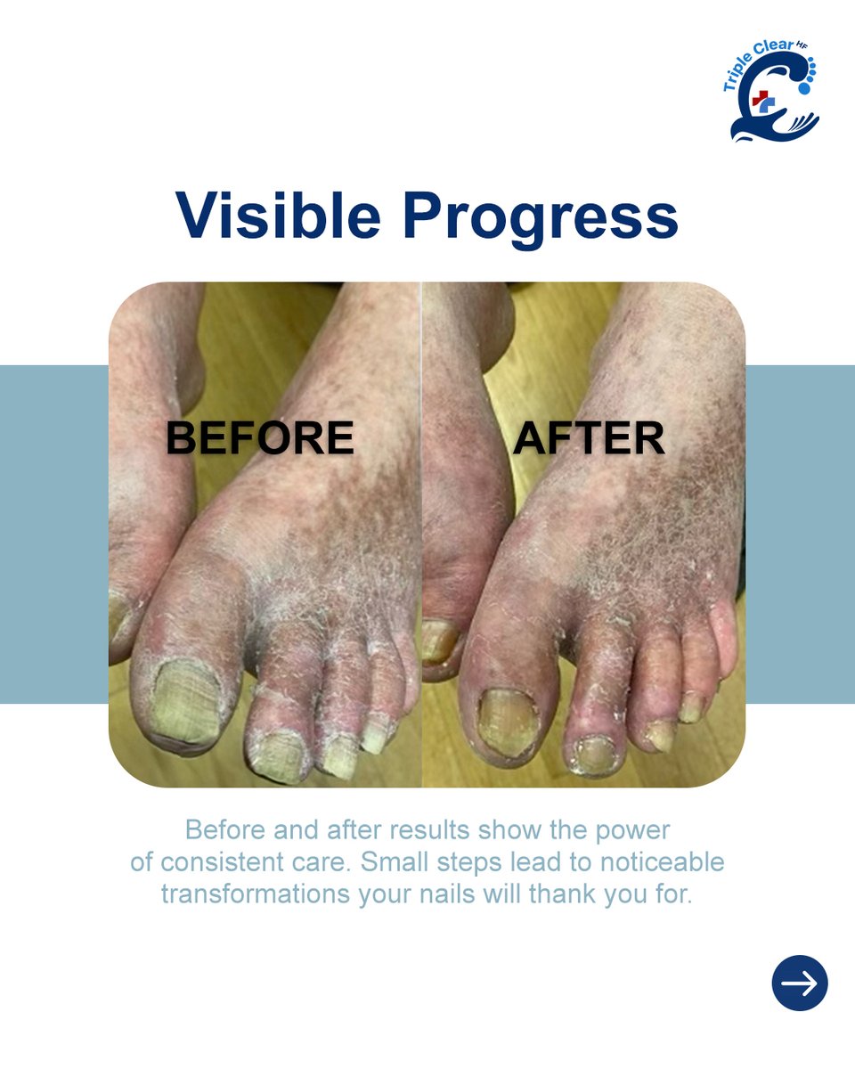 TripleClearHF's tweet image. Consistency matters in nail health.

Triple Clear HF treats multiple nail concerns while protecting nails through simple daily use.

Apply, absorb, and let steady care support healthier growth over time.

Start today at TripleClearHF.com.

#TripleClearHF #NaturalNailCare