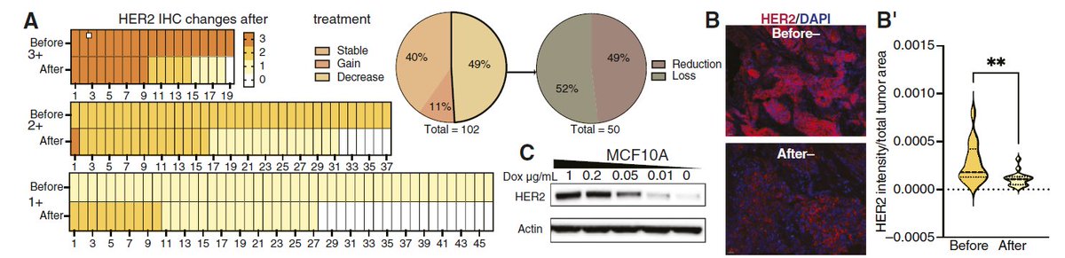 jsoriamd's tweet image. 🧬🛡️ HER2-low tumors escape HER2 ADCs by losing the target
• True HER2 loss is uncommon in HER2-amplified disease but frequent in HER2-low, where HER2 isn’t oncogenic
• On HER2 ADC therapy, ~50% of tumors reduce HER2; among reducers, ~half become IHC 0
• Reduced HER2 →…