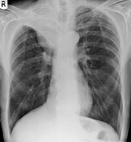 CHEST X-RAY 48: What is the name of this radiological sign and what does it signify? Answer buff.ly/40kBvSa