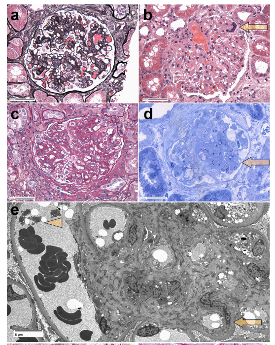 Spectrum of Kidney #Biopsy Findings in a Patient With Primary #Myelofibrosis

 doi.org/10.1016/j.ekir…

#KIRNephrologyRounds