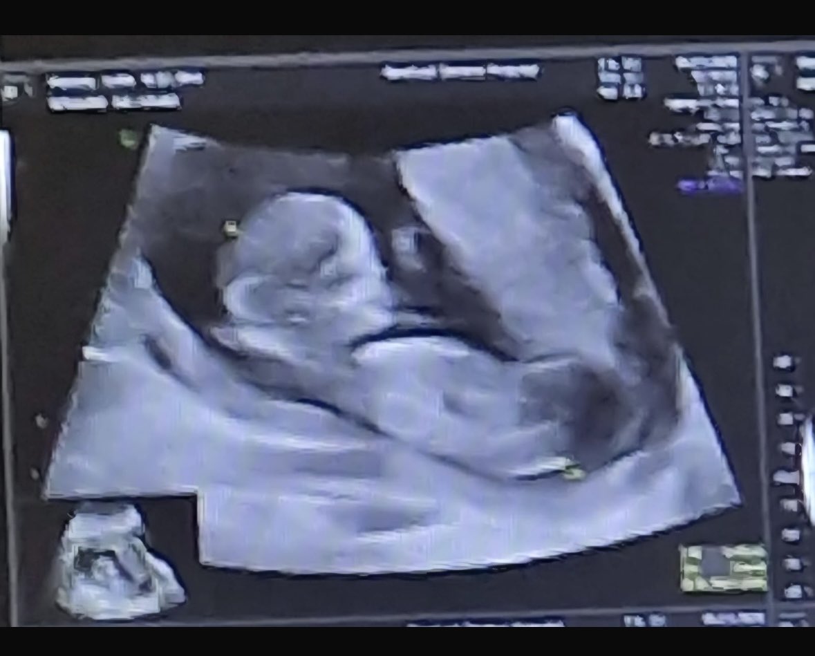 Best news in 2026 - our Jodie &amp; Tom are expecting in July - about to be a grandad 😁😁😁😁😁