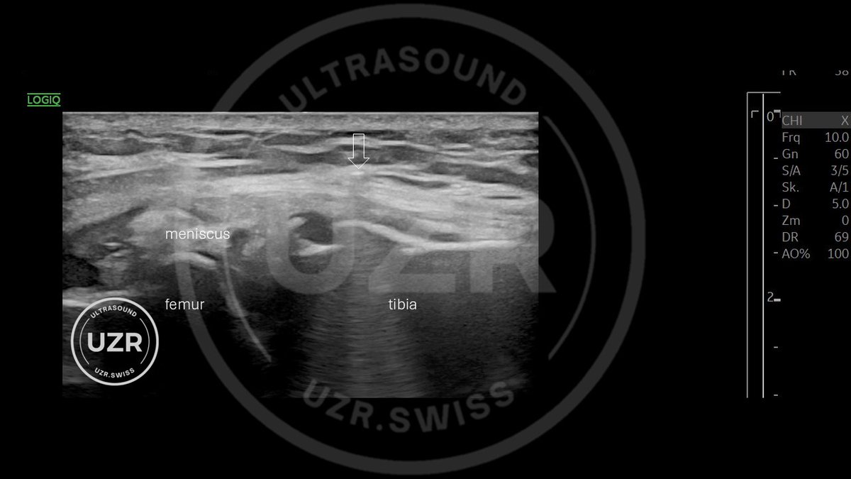 Ultrasound quiz.
Level: unsolvable
Knee.
What is marked with the arrows?