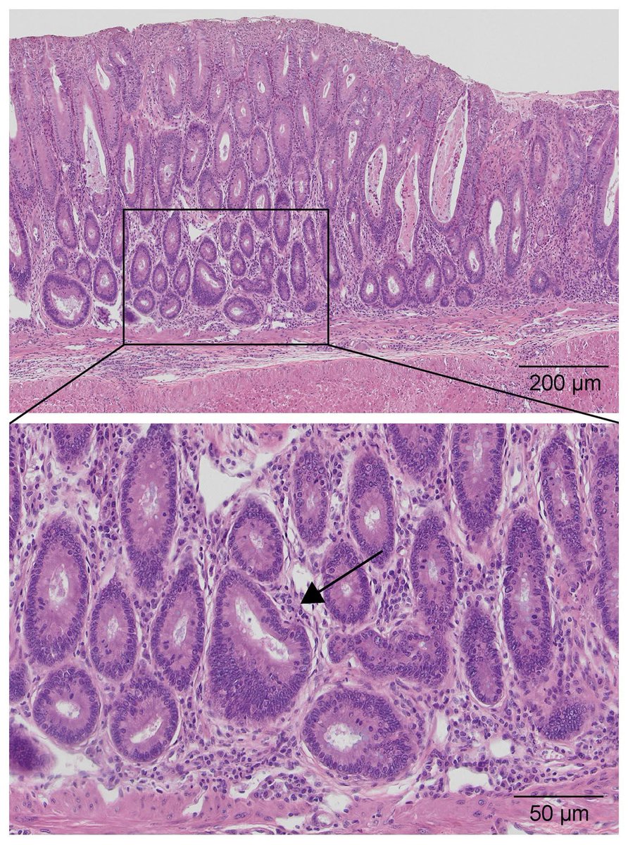 Is colon cancer a transmissible disease via the microbiome? 

jci.org/articles/view/…