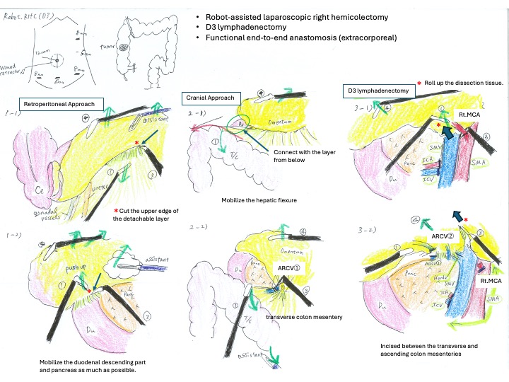 jses_eng's tweet image. JSES IllustCon 66
📌Robot.RHC with standardized surgical view
📝Robot-assisted laparoscopic right hemicolectomy (D3)
🖊Kunitomo Aina
#JSESイラストコンテスト　#JSES_illustration_contest