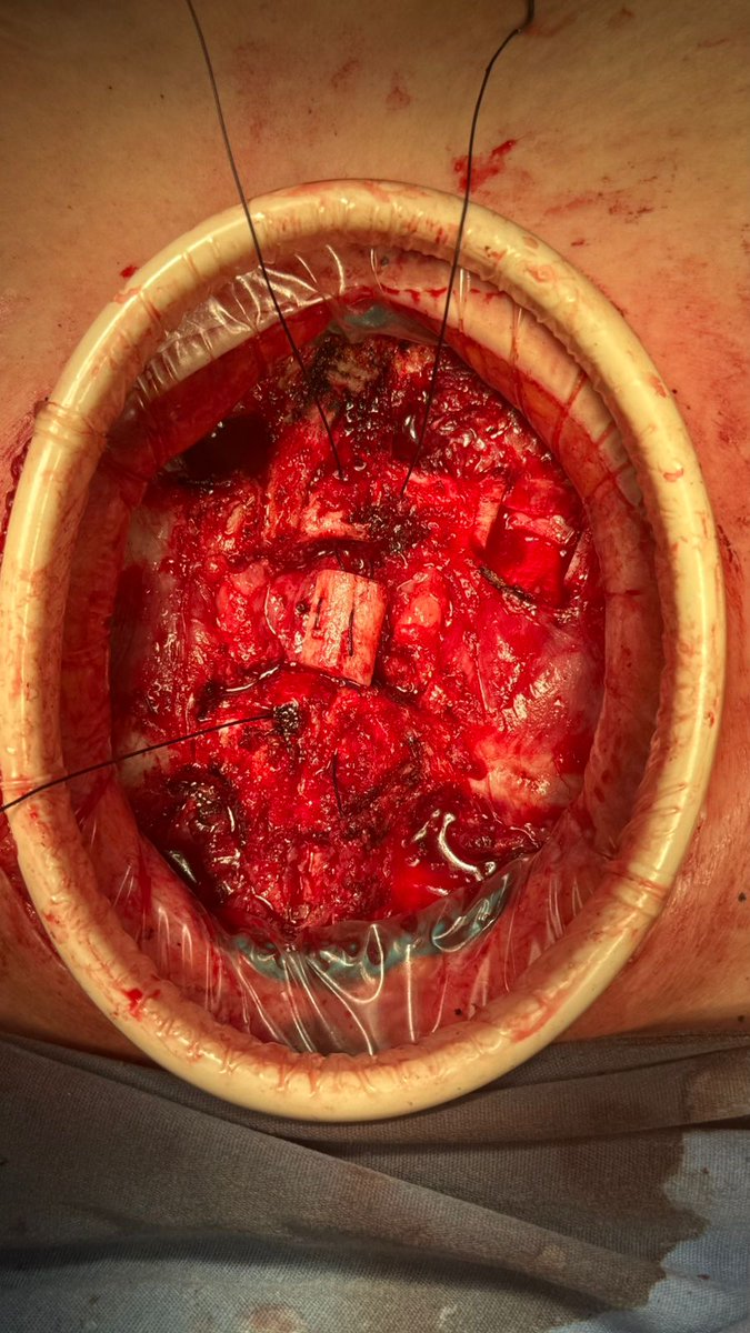 RodrigoRostro's tweet photo. Dehiscencia esternal reparada. Sistema clip MedXpert + injerto costal https://t.co/wEX9iSlHET