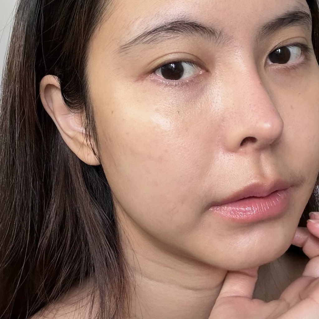 peartunwarat's tweet image. ย้อนกลับมาไปดูรูปก่อนและสังเกตุตัวเอง สิวที่ทิ้งรอยไว้มันจางลงมาก รู้เลยสกินแคร์ตัวไหนช่วย เพราะไม่ค่อยเปลี่ยนสกค และใช้ซ้ำบ่อยสุด เรื่องความไบร์ท/รอยดำ ให้ เซรั่ม ลอรีอัล ขวดนี้แหละไปต่อยาวๆ ไม่ตามกระแสด้วย