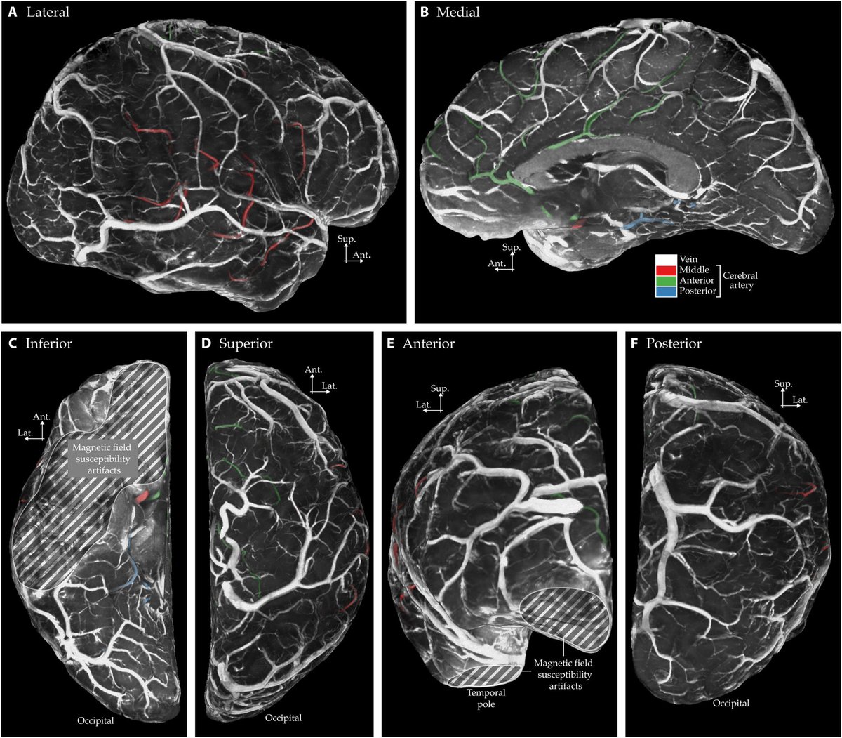 Beyindeki en ince damarlara kadar tüm damarları, ilaç vermeden, günümüzde kullanılan MR yöntemlerine göre çok daha kısa sürede (7 dakika) ve çok daha ayrıntılı gösteren yeni bir MR protokolü geliştirildi.

<a href="/ScienceMagazine/">Science Magazine</a>