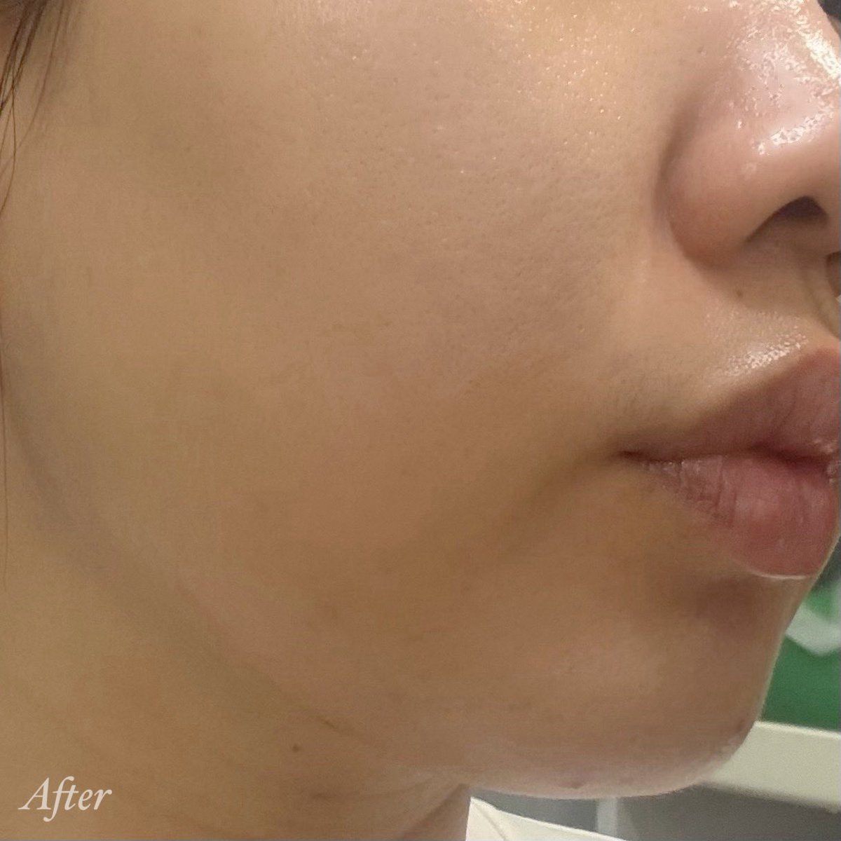 Chiuter's tweet photo. ฝากตัวไว้กับ La Roche-Posay Effaclar มาตลอด โดยเฉพาะมอยซ์ DUO+M คือตอบโจทย์มากก No.1 เรื่องสิว เข้าใจคนผิวมัน รูขุมขนกว้าง เป็นสิวง่าย ตัวนี้ช่วยปรับสมดุลแบคทีเรียบนไมโครไบโอม ลดความมันส่วนเกิน ลดโอกาสเป็นสิวซ้ำ ผิวแข็งแรงขึ้นจริงในระยะยาว https://t.co/IbV3Jpohc6