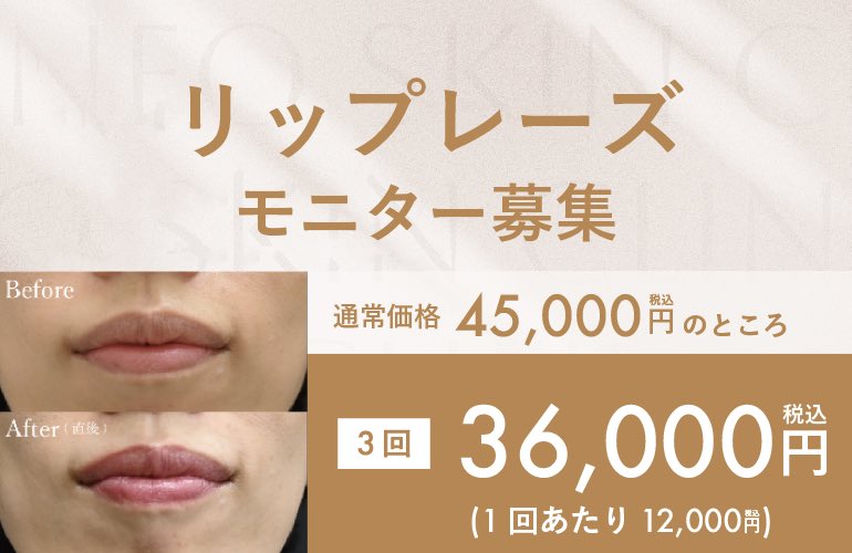 1月のモニターキャンペーン⛄️🤍

治療詳細はこちら▶︎ s.s-b-c.net/10c4ou3d