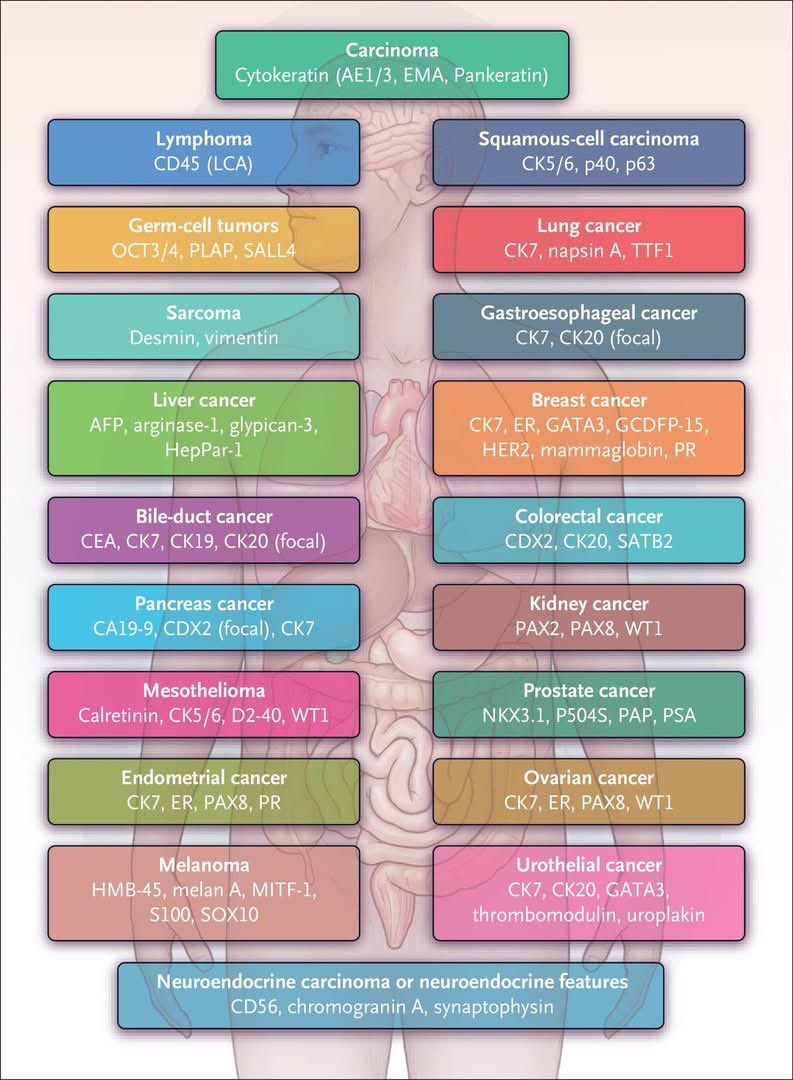 rksanti's tweet photo. 🧬Cáncer de origen primario desconocido (CUP): el diagnóstico se apoya en marcadores tumorales séricos (CA-125, CEA, PSA, AFP, β-HCG), pero la clave está en la inmunohistoquímica. Patrones como CK20+, CDX2+ y SATB2+ orientan a origen colorrectal; CK7/TTF-1 a pulmón; ER/PAX8/WT1 a ginecológico; PSA/NKX3.1 a próstata.
La biología molecular identifica blancos tratables “agnósticos de tejido”: BRAF V600E, NTRK/RET fusions, HER2 (3+), dMMR/MSI-H y TMB alto, que guían terapias dirigidas o inmunoterapia.
📚N Engl J Med. 2025;392:2035-2047. doi:10.1056/NEJMcp2402691
Únete y descarga el pdf completo aqui: https://t.co/2liH0rXsup