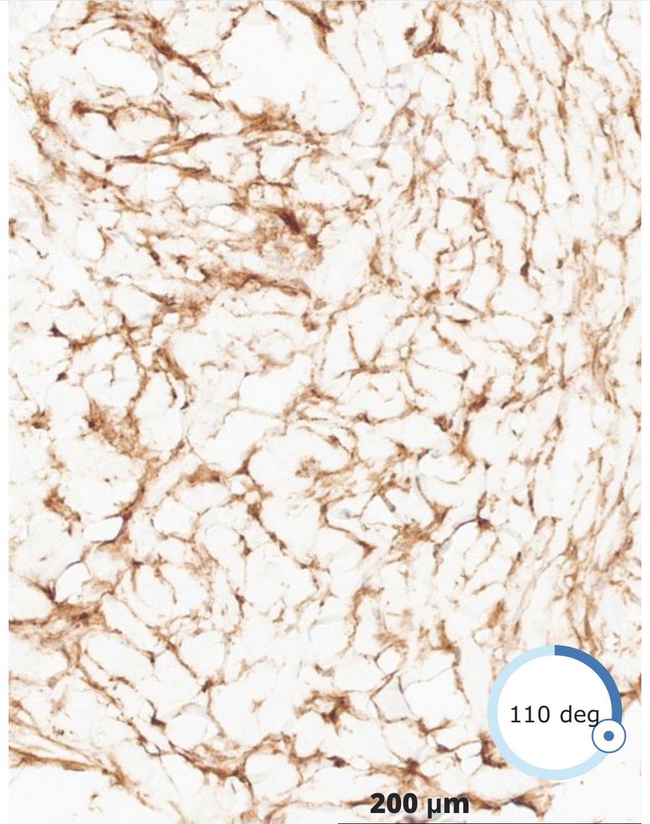 DrBuiPathology's tweet image. #DrBuiBSTCaseCollection 🌻Keloidal—type Collagen in Desmoid Fibromatosis. A rare finding in a relatively common disease, demonstrated with β-catenin staining.⁦@MoffittNews⁩ ⁦@USFpathology⁩ ⁦@CAPA_comm⁩ #sarcoma #PathX #Pathtwitter