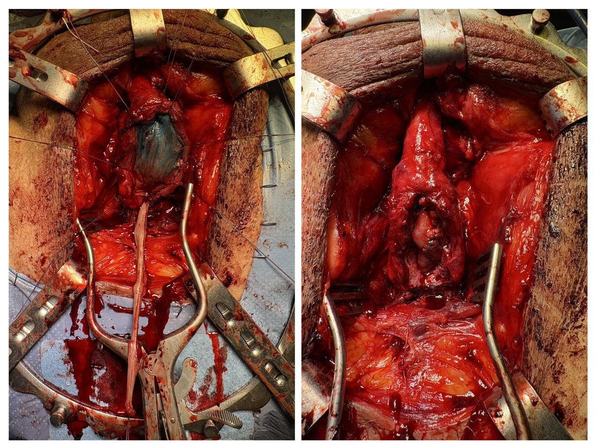formosourologia's tweet photo. En la Unidad de Cirugía Reconstructiva Urológica del Hospital Universitario Rey Juan Carlos comenzamos el año con ganas. Esta semana hemos realizado dos uretroplastias complejas de aumento. ¿Y ustedes, qué preferencias tienen? Injerto ventral o dorsal?
#uretroplastia #urologia https://t.co/4u2ue3YBNP