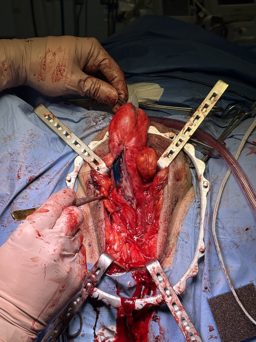 formosourologia's tweet photo. En la Unidad de Cirugía Reconstructiva Urológica del Hospital Universitario Rey Juan Carlos comenzamos el año con ganas. Esta semana hemos realizado dos uretroplastias complejas de aumento. ¿Y ustedes, qué preferencias tienen? Injerto ventral o dorsal?
#uretroplastia #urologia https://t.co/4u2ue3YBNP