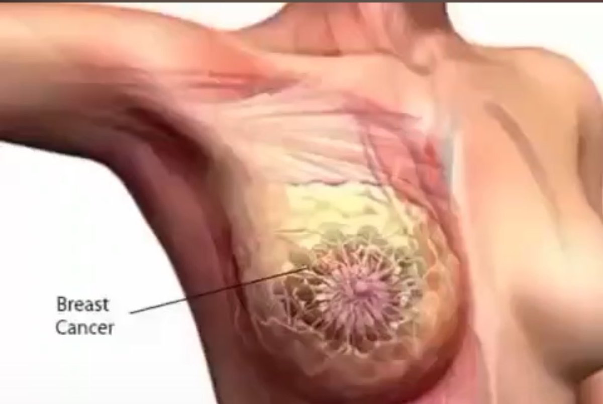 Theoladeledada's tweet image. Please If you know of any lady battling BREAST CANCER of whatever stage please advise her to contact: Dorothy@africacancerfoundation.org

All medical expenses are free. Please don't keep this message to yourself, SHARE OR FORWARD to groups and save that woman's life today.…