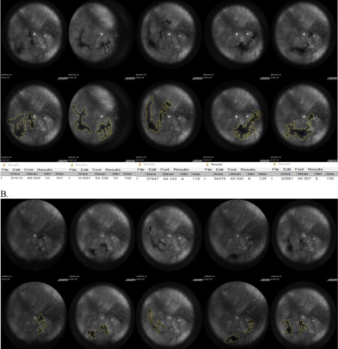Outdoctrination's tweet image. Eye floaters extinguished with nutrients.

Before (top) &amp;amp; after (bottom) 6 mo after taking:

⬩125 mg l-lysine
⬩40 mg vit C
⬩26.3 mg grape vine extract
⬩5 mg zinc
⬩100 mg sour orange extract

in a clinical trial.

Eye floaters are caused by damage to eye collagen, and can be…