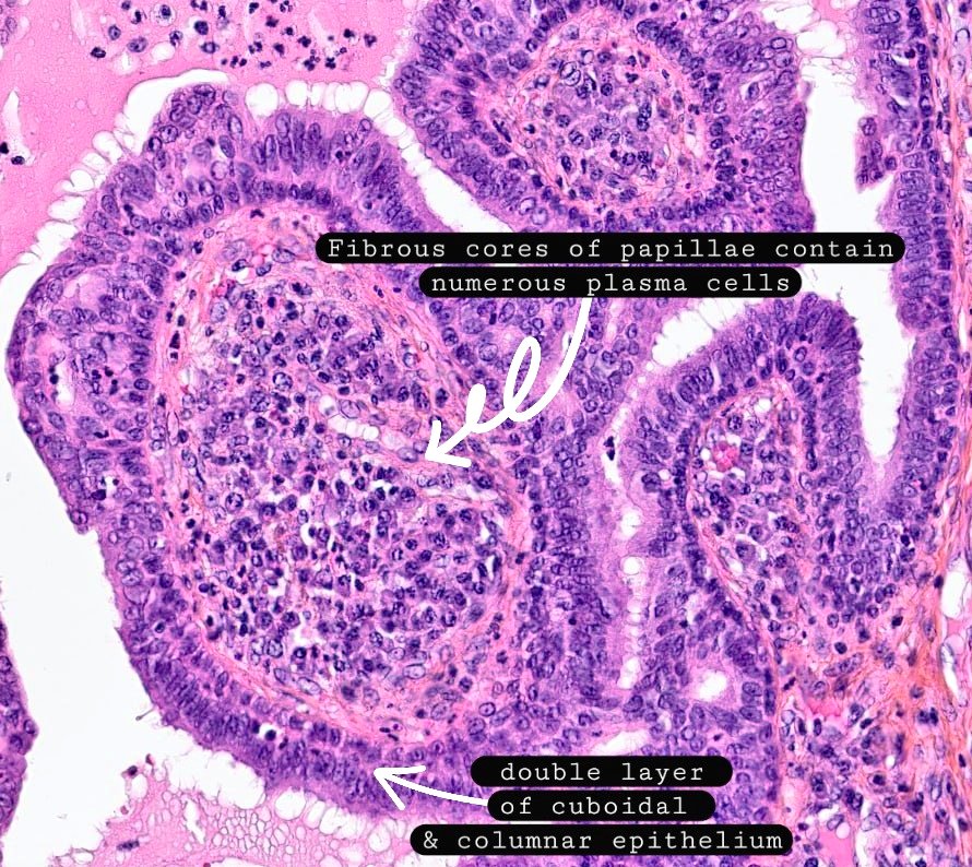 Syringocystadenoma papilliferum (SCAP) :

✔️Benign adnexal tumor
✔️Most commonly occurring in the head and neck in early childhood  ✔️Glands with epidermal connection,  double layer of cuboidal columnar epithelium and numerous stromal plasma cells

#dermpath #xpath #pathology