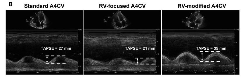 EmergPOCUS's tweet photo. 📐 Cuál es el mejor plano para medir el #TAPSE? 🤔
👇🏼 🧵 🪡 #HILO 🪡 🧵👇🏼
La excursión sistólica del plano anular tricuspídeo (TAPSE) es el parámetro cuantitativo más utilizado.
La función sistólica del ventrículo derecho es clave en muchas enfermedades cardiovasculares 🫀.
🔍 ¿Qué hicieron en el estudio?
•Compararon 3 planos apicales:
•A4C estándar
•A4C enfocado a VD
•A4C modificado del VD
•Evaluaron:
•Valor de TAPSE
•Ángulo de incidencia del haz
•Correlación con strain longitudinal del VD
•Reproducibilidad intra e interobservador
#POCUS #Ecocardiografía #Urgencias #FOAMed