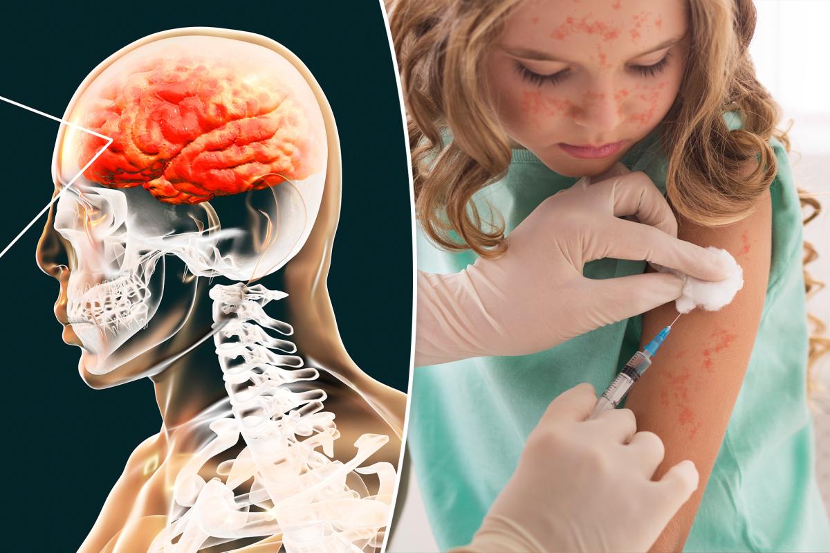nypost's tweet image. The horrific measles complication that can kill you years later — as nearly 200 cases confirmed across US trib.al/eptMqCC