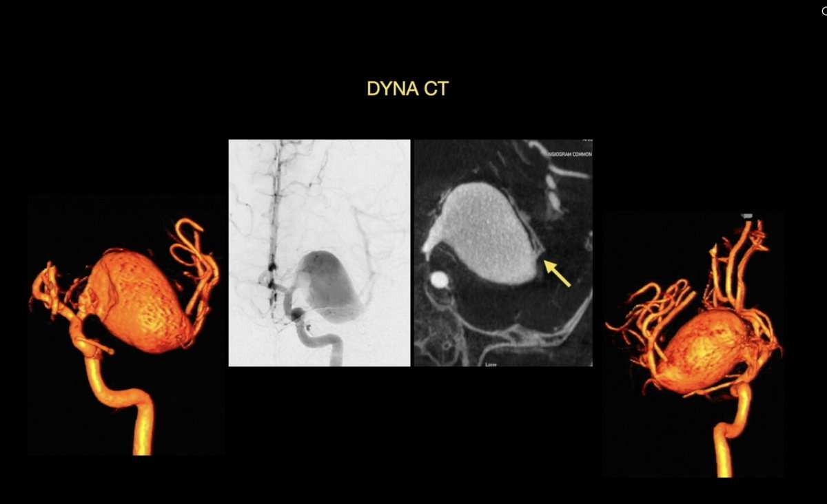drufukerginoglu's tweet photo. 🧠 New paper in Operative Neurosurgery:

Flow-diverting bypass for giant fusiform aneurysms when standard options fail.

DOI: 10.1227/ons.0000000000001865
#Neurosurgery #UWHealth #UWMadison 🦡 https://t.co/oUng1XZv4V