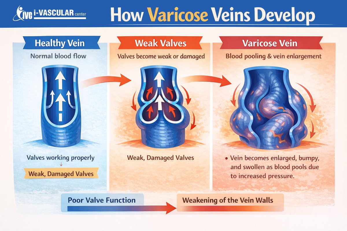 ivascularAB's tweet photo. When vein valves become week or damaged, blood begins to pool causing vein enlargement. As the veins enlarge, they become swollen and bumpy. Vascular treatments can restore blood flow and improve the look of your legs. Learn more at https://t.co/muK1I581VD or call 325-268-4040. https://t.co/C2Oh91Uh4C