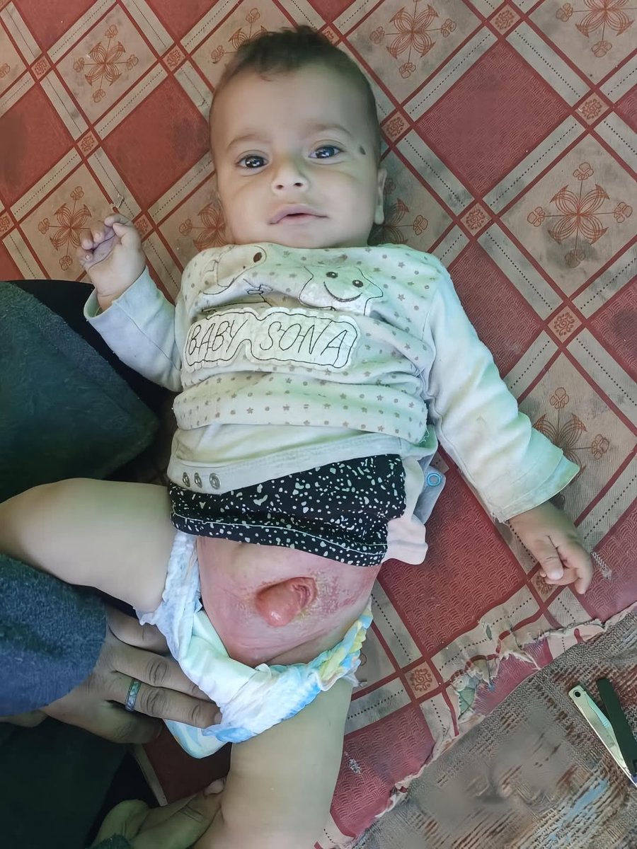 EyeonPalestine's tweet image. Nader Iyad Al-Sarsawi, a 1 year and 9 months old child, suffers from a congenital colon condition.
He has undergone a colostomy surgery and urgently needs another operation.
His condition is very serious, with constant pain and bleeding.