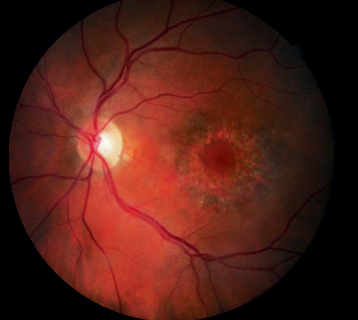 revoptom's tweet image. How to Get the Most Out of Expert Guidance Documents in Eye Care

Evidence-based recommendations can inform clinical decisions in the right circumstances. Here’s a look at the lessons—and limitations—they bring to optometry: reviewofoptometry.com/article/how-to…
#optometry #eyecare #eyedoctor