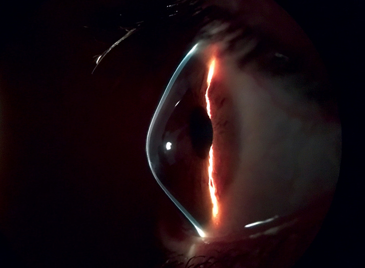 revoptom's tweet image. Sex-hormone Changes Can Modulate Keratoconus

Fluctuations in estrogen and progesterone—particularly during pregnancy—may contribute to corneal instability. Read more:
reviewofoptometry.com/news/article/s…
#cornea #keratoconus #optometry